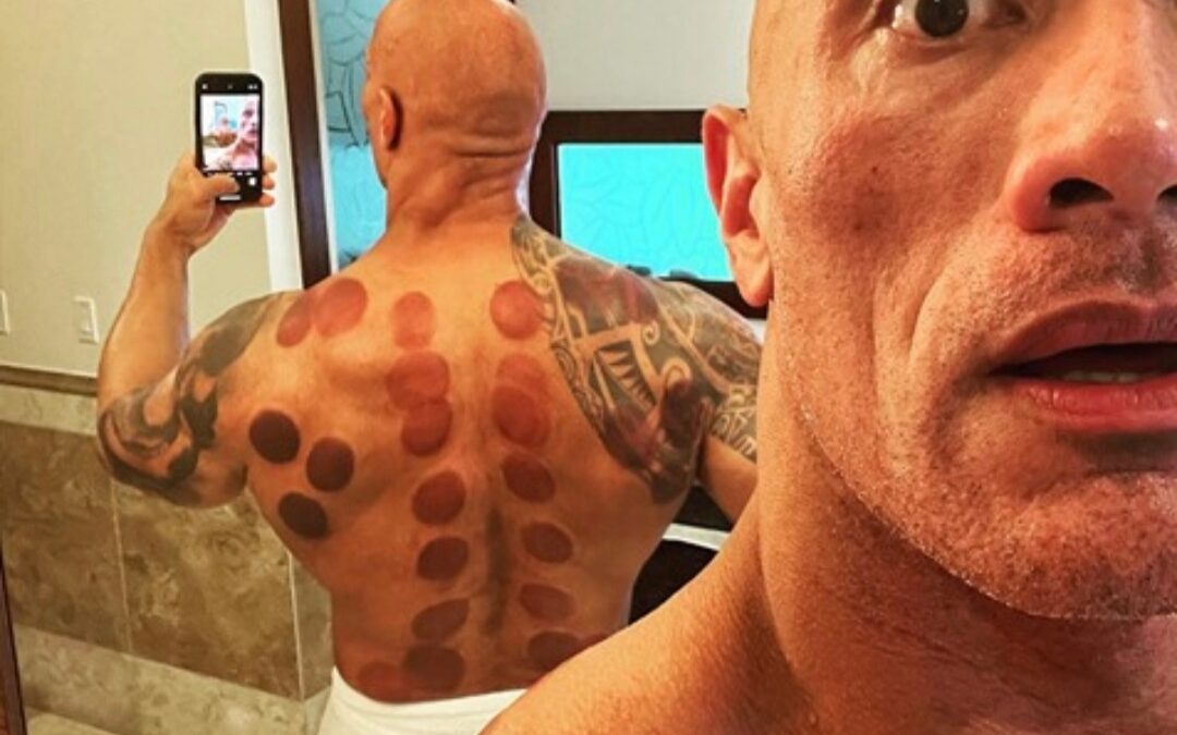 Dry Cupping – And How Can It Help You